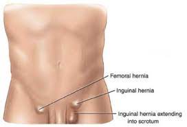 Groin hernia and you - British Hernia Society